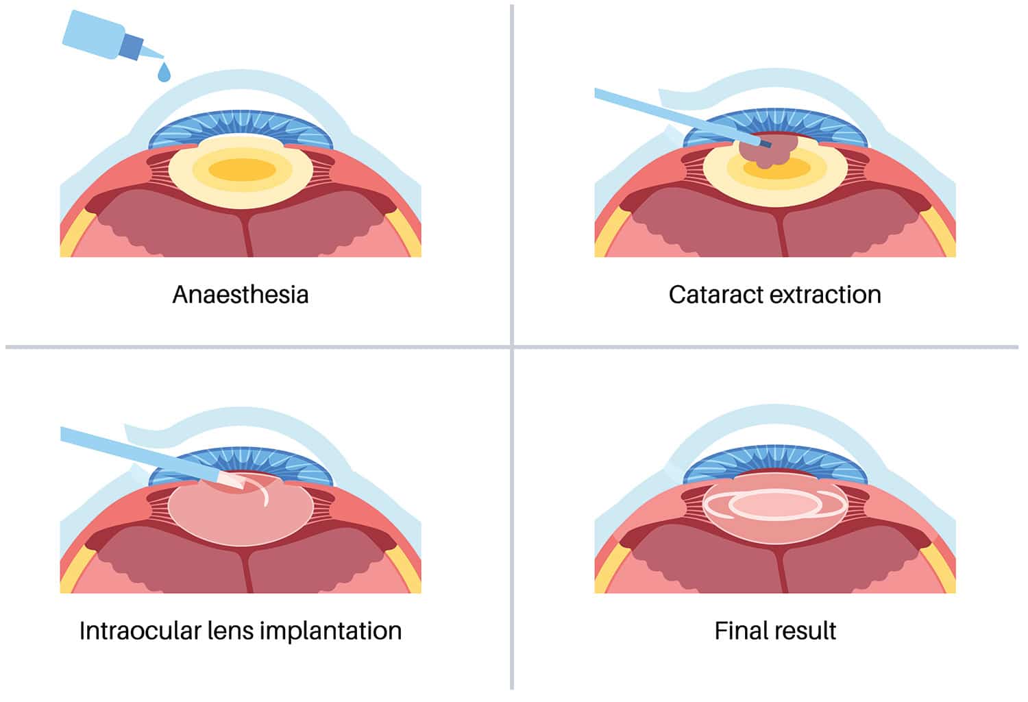 Adanced Cataract Surgery Warrenton | Cataract Surgery Manassas