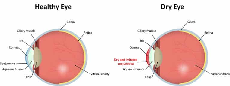 Healthy eye compared to dry eye
